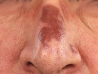 Granuloma faciale