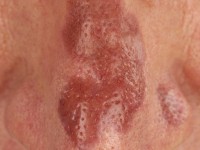 Granuloma faciale