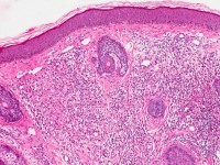 Histologie van granuloma faciale