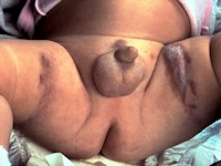 Granuloma gluteale infantum