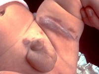 Granuloma gluteale infantum