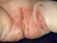 Granuloma gluteale infantum