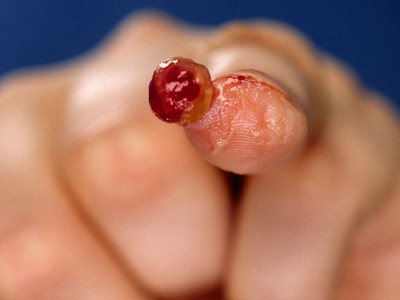 granuloma pyogenicum