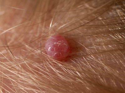 granuloma pyogenicum
