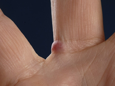 Granuloma pyogenicum (synoniemen: granuloma teleangiectaticum, pyogenic granuloma, lobular capillary hemangioma)