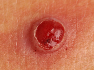 granuloma pyogenicum