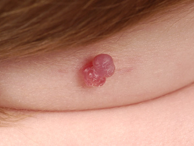 granuloma pyogenicum