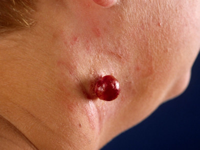 granuloma pyogenicum