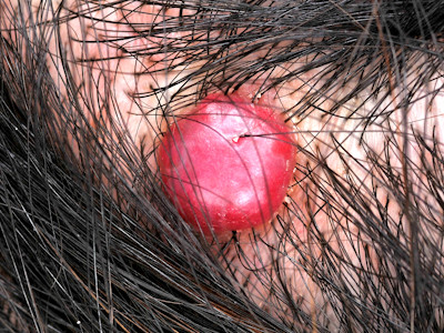 Granuloma pyogenicum (synoniemen: granuloma teleangiectaticum, pyogenic granuloma, lobular capillary hemangioma)