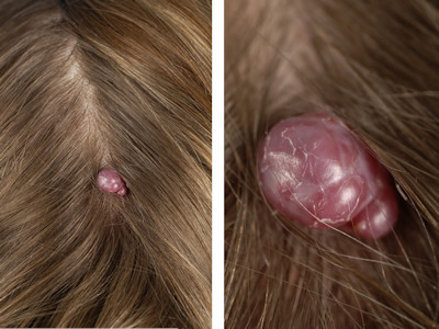 granuloma pyogenicum