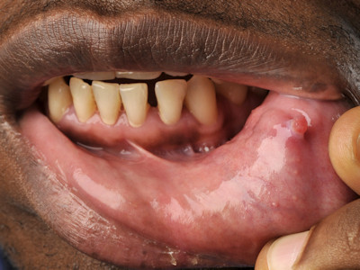 Granuloma pyogenicum (synoniemen: granuloma teleangiectaticum, pyogenic granuloma, lobular capillary hemangioma)