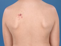 Agminated pyogenic granuloma