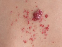 Agminated pyogenic granuloma