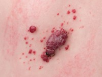 Agminated pyogenic granuloma