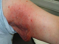 Granulomatous slack skin