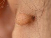 Haarfollikelnaevus of accessoir oor