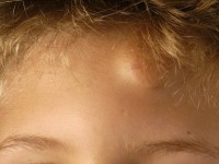 Haemangioma cavernosum