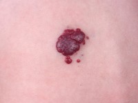 Haemangioma fructuosum, strawberry hemangioma