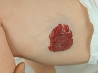 Haemangioma fructuosum, strawberry hemangioma