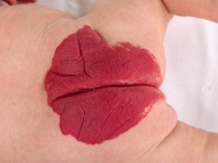 Haemangioma fructuosum, strawberry hemangioma