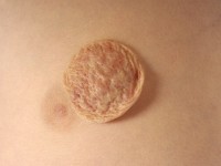 Haemangioma fructuosum, strawberry hemangioma