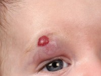 Haemangioma fructuosum et cavernosum
