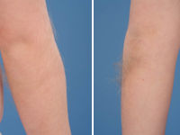 Hairy elbow syndrome