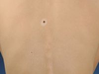 Halo nevus (Sutton nevus)