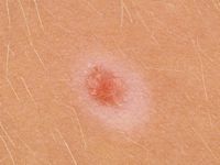 Halo nevus (Sutton nevus)