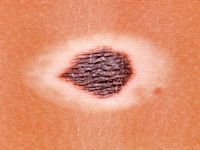 Halo nevus (Sutton nevus)