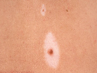 Halo nevus (Sutton nevus)