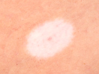Halo nevus (Sutton nevus)