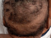 Halo scalp ring