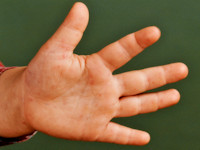 Hand foot and mouth disease