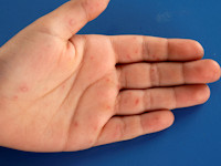 Hand foot and mouth disease