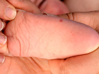 Hand foot and mouth disease
