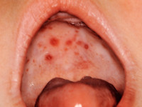 Hand foot and mouth disease