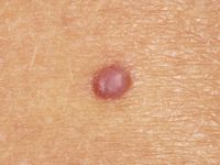 Hemangioom op oudere leeftijd