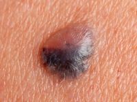 Hemangioom op oudere leeftijd