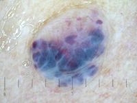 Hemangioom op oudere leeftijd