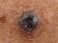 Hemangioom op oudere leeftijd