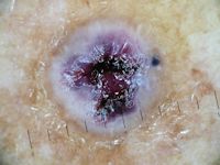 Hemangioom op oudere leeftijd