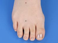 Hemangioom op oudere leeftijd