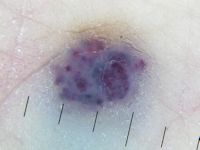 Hemangioom op oudere leeftijd