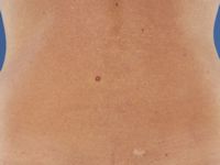 Hemangioom op oudere leeftijd