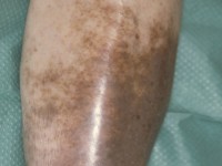 Hemosiderine pigmentatie