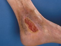 Hemosiderine pigmentatie