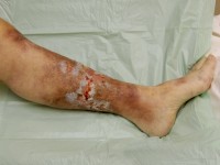 Hemosiderine pigmentatie