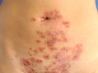 Herpes gestationis (pemphigoid gestationis)