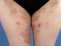 Herpes gestationis (pemphigoid gestationis)